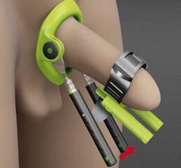 Réhabilitation après une opération pour augmenter le pénis