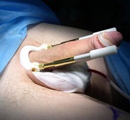 comment une opération pour augmenter le pénis est effectuée